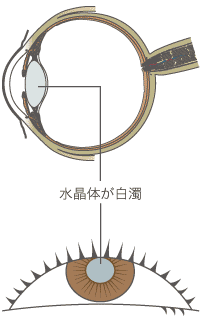 白内障図