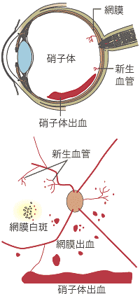 硝子体出血